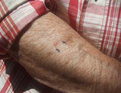 Electronic heat spot was built to experimentally treat skin growths